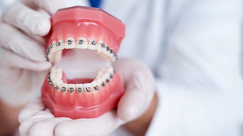 Motivos para não parar o tratamento ortodôntico: veja! - Dental Arte