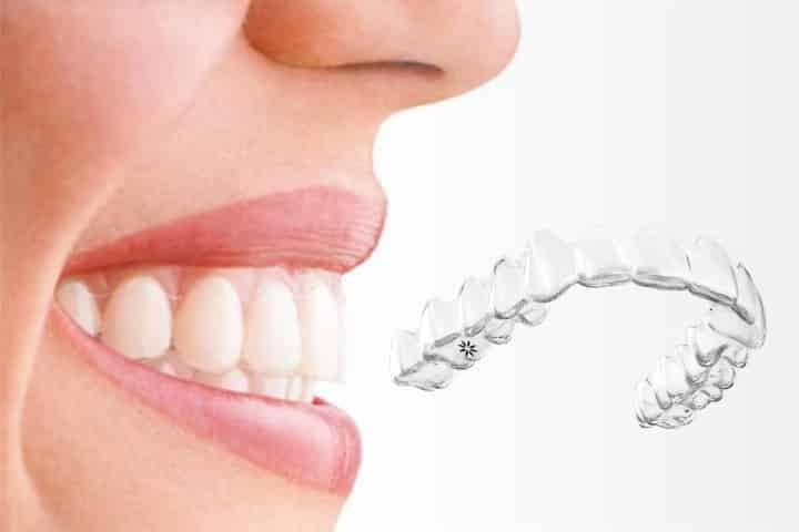 Quando é possível perceber os resultados com o Alinhador Invisível?  Confira! - Dental Arte